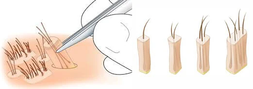 Illustration verschiedener Grafts mit unterschiedlich vielen Haaren