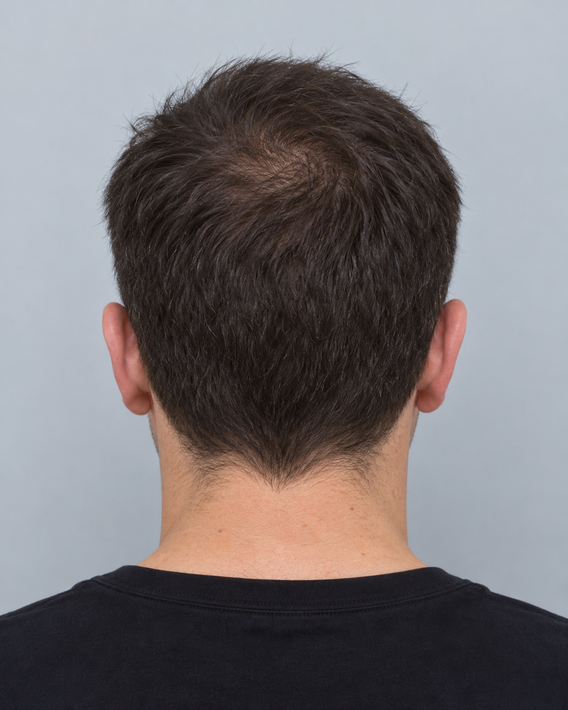 Beispielfoto Hinterkopf und Nacken für eine Haaranalyse