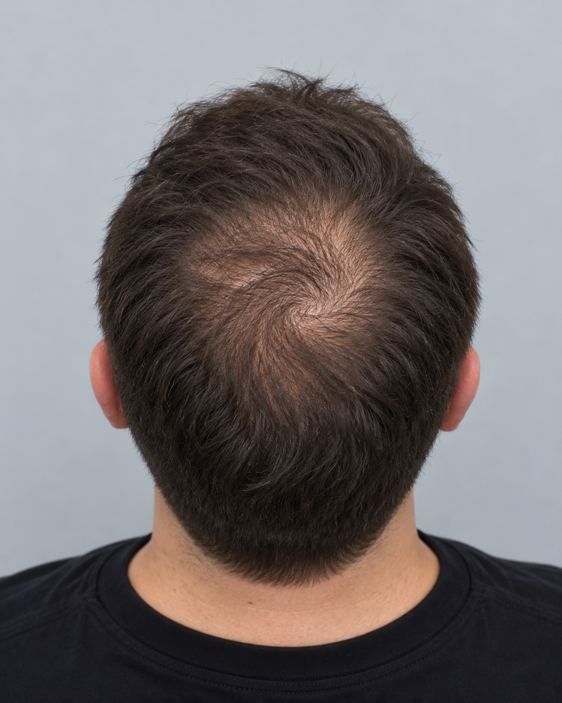 Beispielfoto Tonsur und Krone für eine Haaranalyse